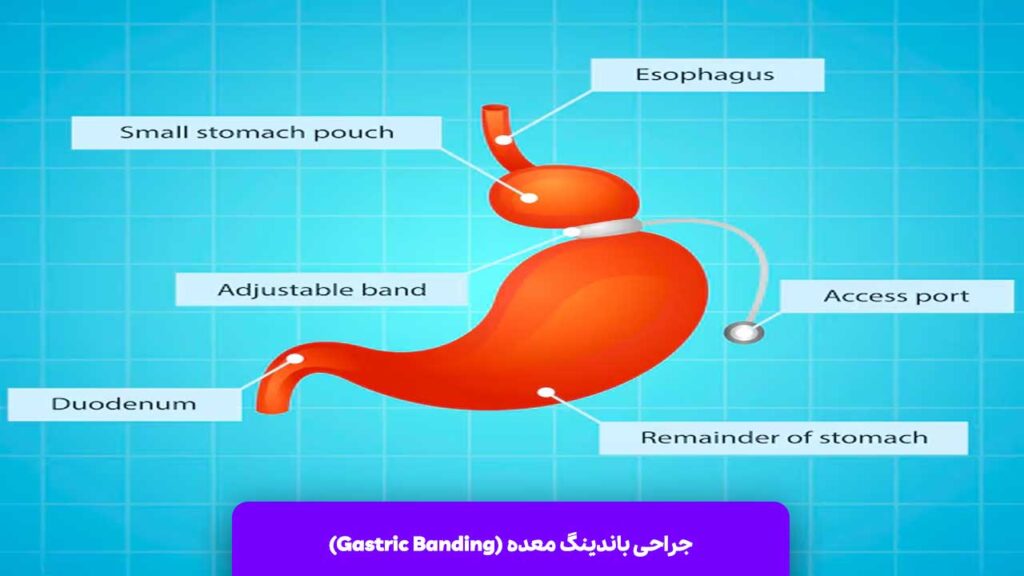 جراحی باندینگ معده (Gastric Banding)