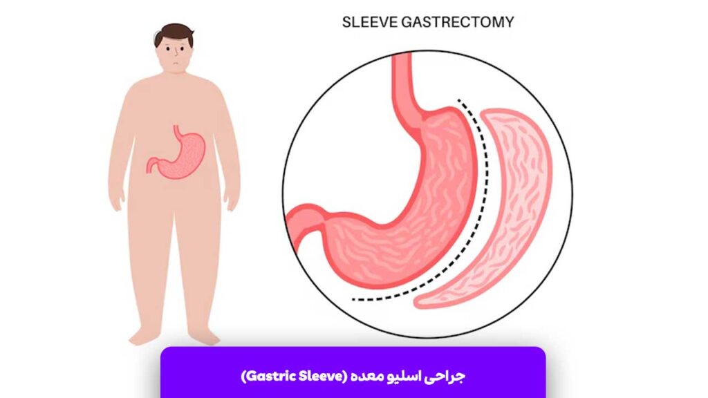 جراحی لاغری اسلیو معده