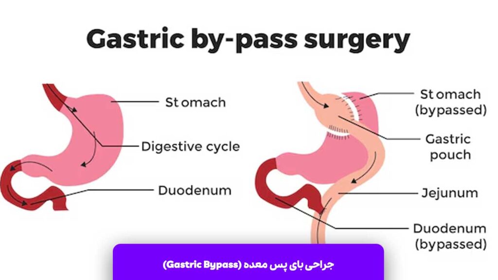 جراحی لاغری بای پس معده