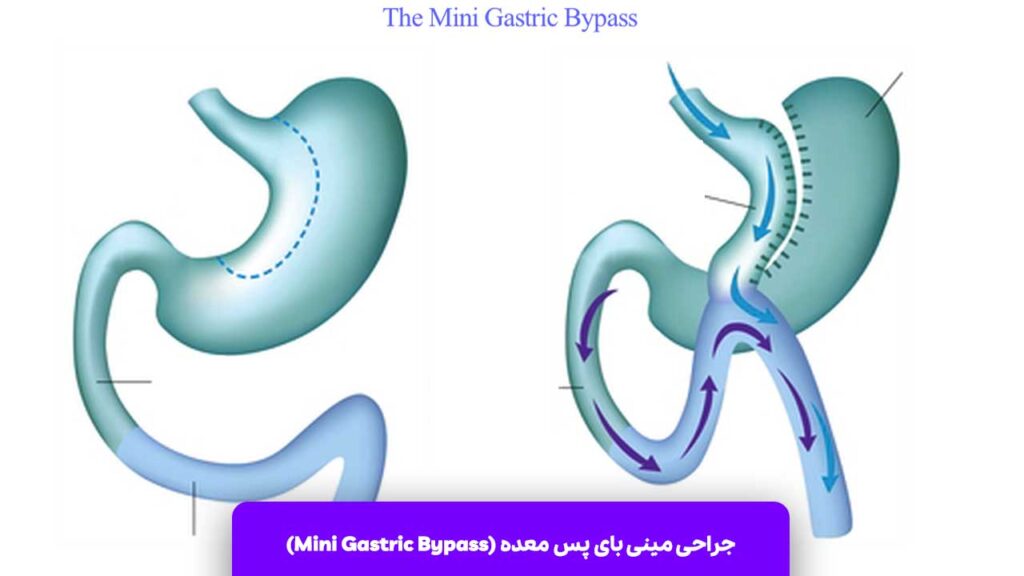 جراحی مینی بای پس معده (Mini Gastric Bypass)