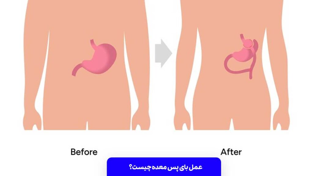 عمل بای پس معده چیست؟