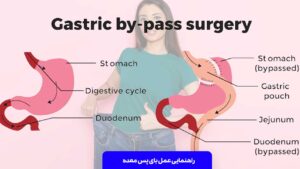 عمل بای پس معده