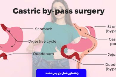 عمل بای پس معده