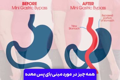 مینی بای پس معده